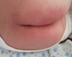 紙尿褲過敏的癥狀