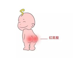 紙尿褲對(duì)寶寶皮膚有影響嗎？